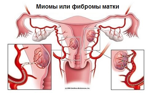 Фіброми матки: 7 тривожних сигналів