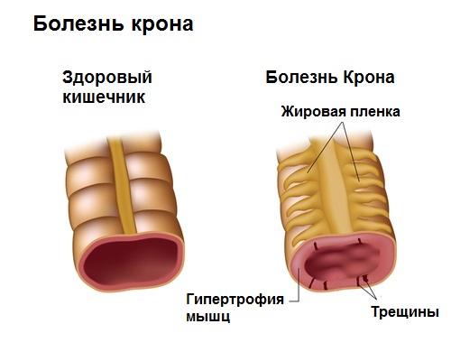 Як правильно харчуватися при Хвороби Крона?