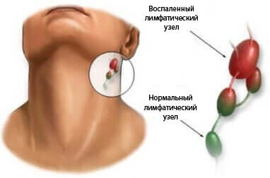 Припухлість на шиї: можливі причини появи