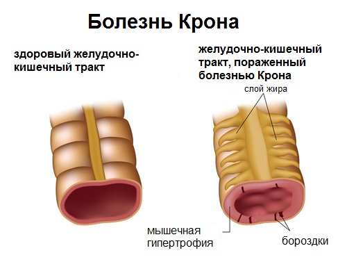 Що таке хвороба Крона?