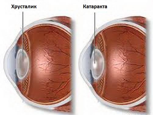 Засоби від катаракти