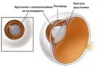 Засоби від катаракти